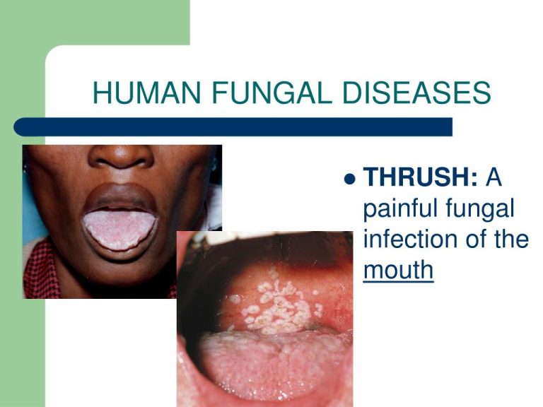 Incredible Examples Of Fungal Infections In Humans 2022